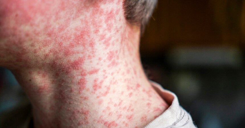 Measles Outbreak Triggers Quarantines in South Carolina Amid Low Vaccination Rates